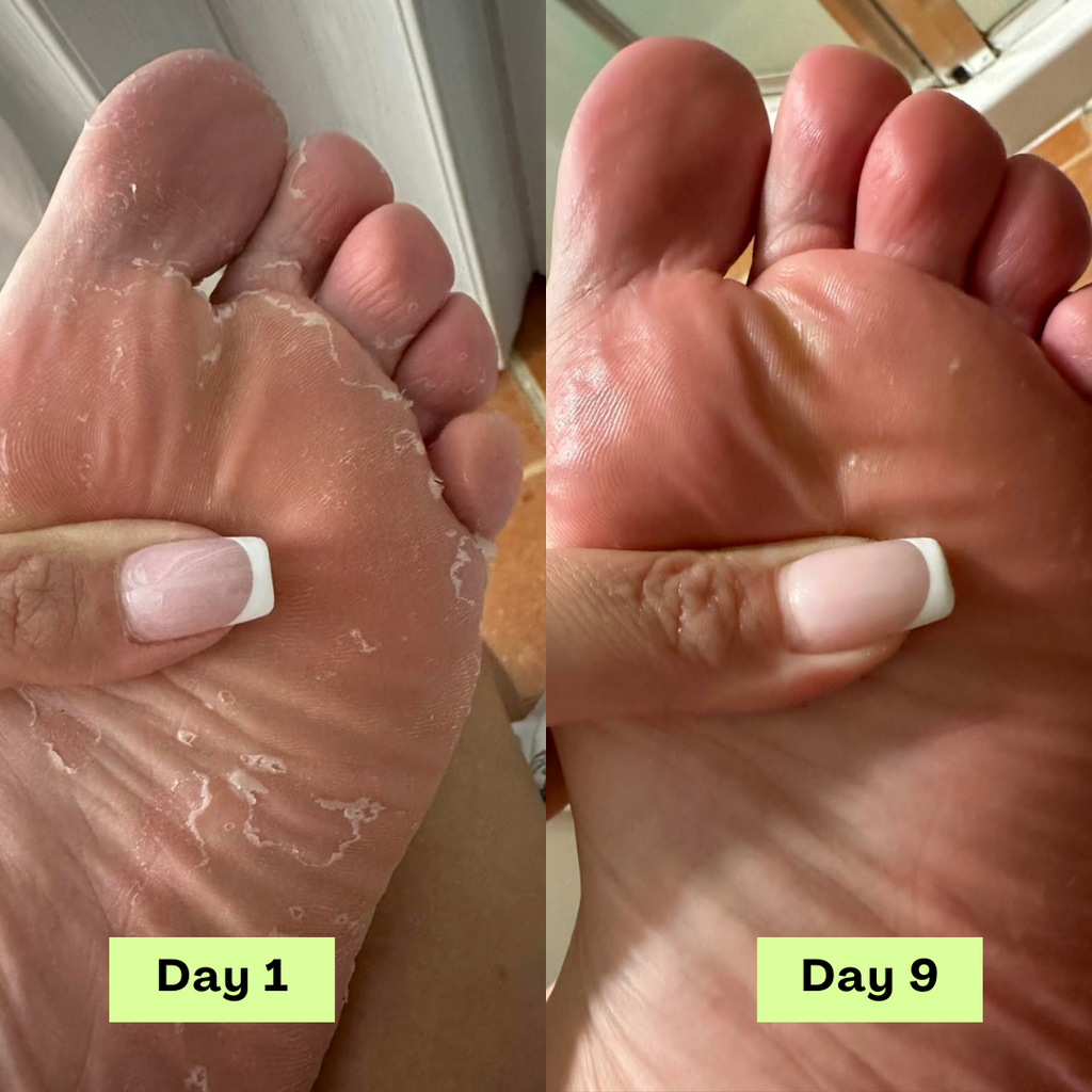 FungiFree® AntiFungal Relief Soap Bar